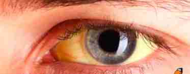 Що робити, якщо білки очей мають жовте забарвлення?