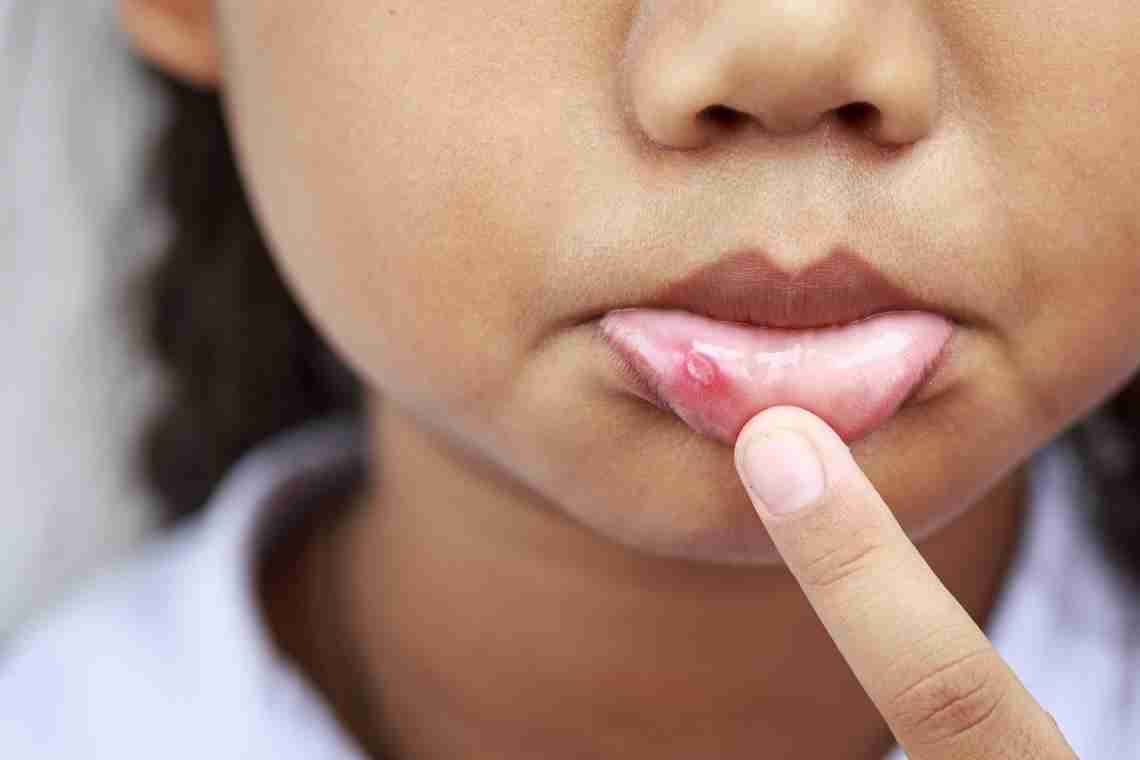 Що робити, якщо лопнула губа: поради для дорослих і дітей