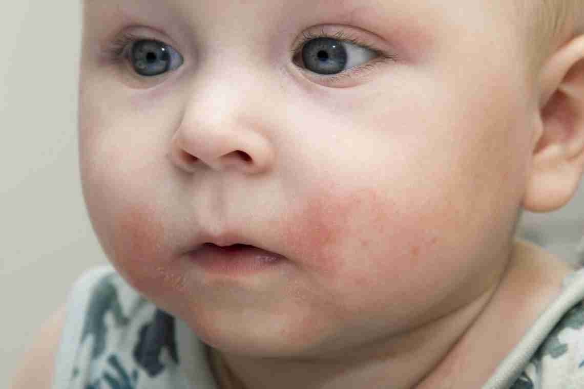 Червоні точки у дитини на обличчі