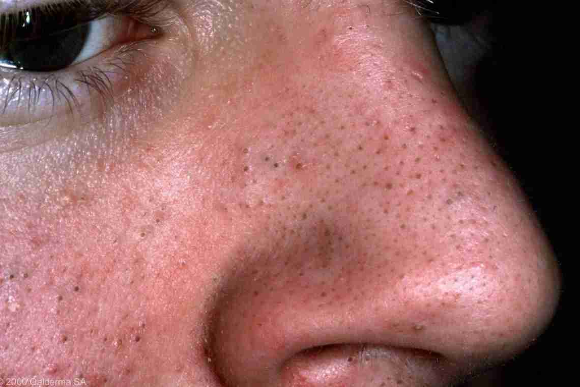 Як позбутися шрамів після прищів на обличчі?