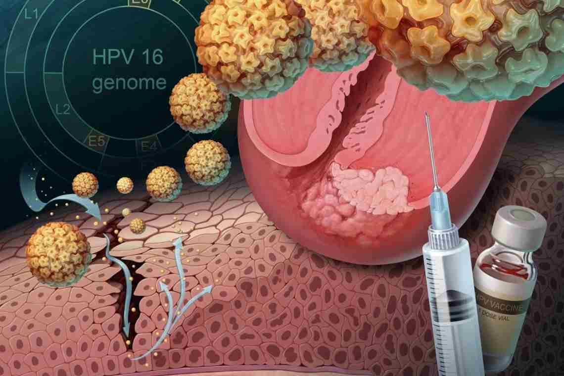 Що таке вірус папіломи людини (ВПЛ) і як його лікувати