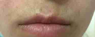 Пігментація над губою: причини появи, способи лікування