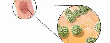 Аналіз на вірус папіломи людини: від бородавок до раку