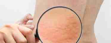 Червоні плями на шиї: причини появи та методи боротьби з даним синдромом