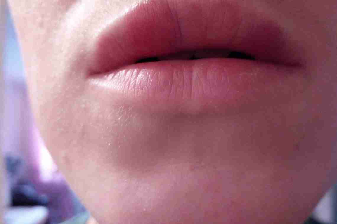 Причини прищів на губах