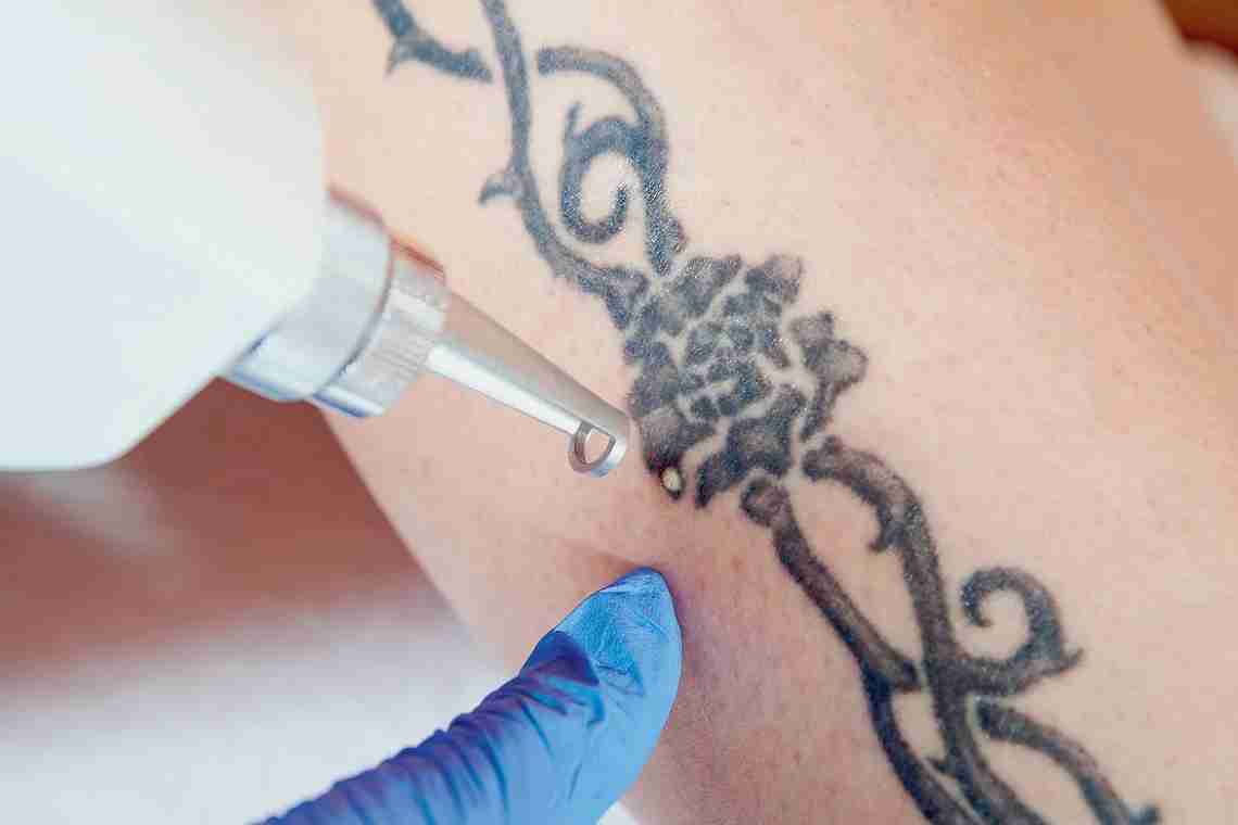 Як звести татуювання: професійні та народні способи