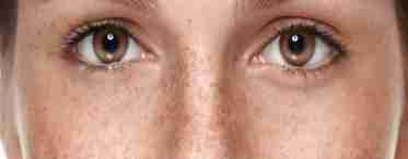 Що потрібно робити, щоб прибрати пігментні плями навколо очей?