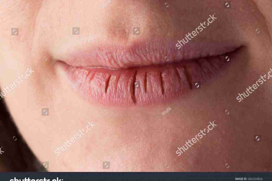 Шелушаться губи - як підібрати способи лікування?