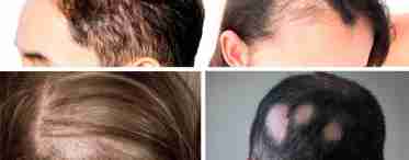При яких хворобах випадає волосся на голові?