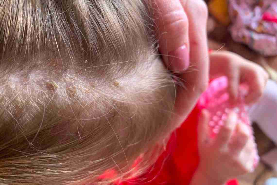 Чому у дітей з'являються себорейні корочки на голові, якими методами лікується недуга?