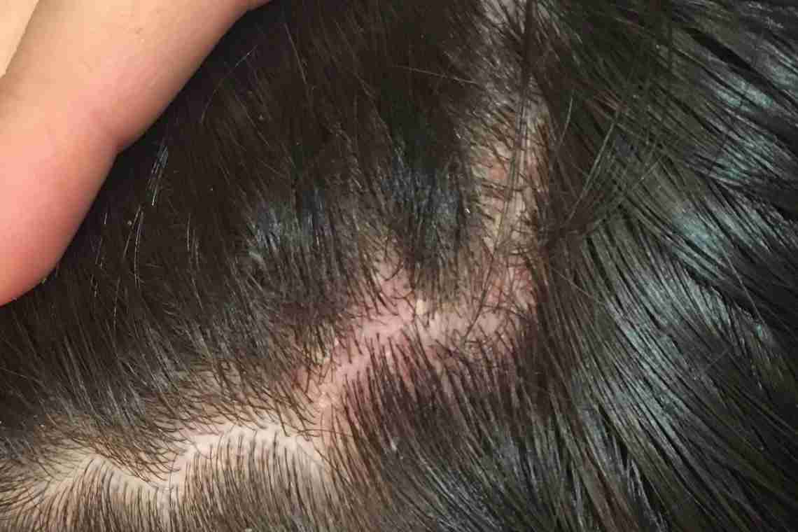 Суха і жирна себорея шкіри голови: причини виникнення та лікування