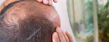 Чи можна відновити волосся після облисіння: цікаві факти про алопецію у чоловіків і жінок