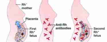 Резус-конфлікт - як виносити здорової дитини!