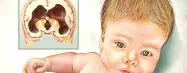 Поширена патологія новонароджених - киста головного мозку