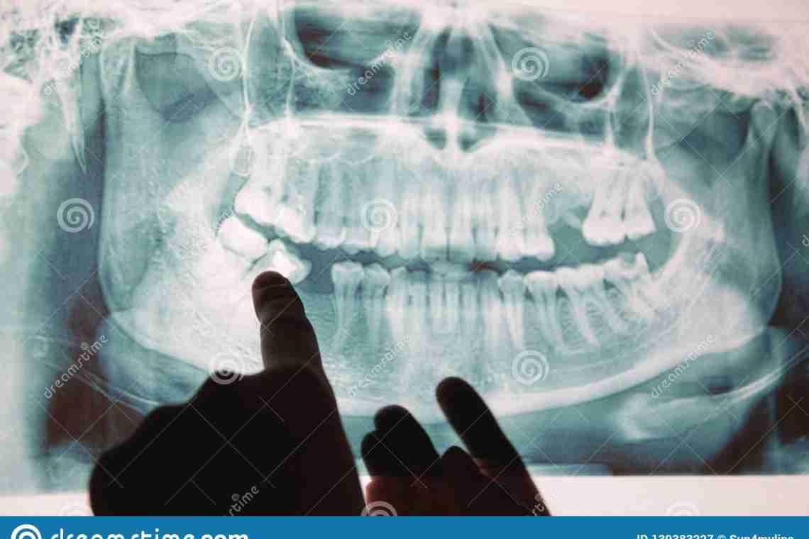 Коли під час вагітності необхідний рентген зуба