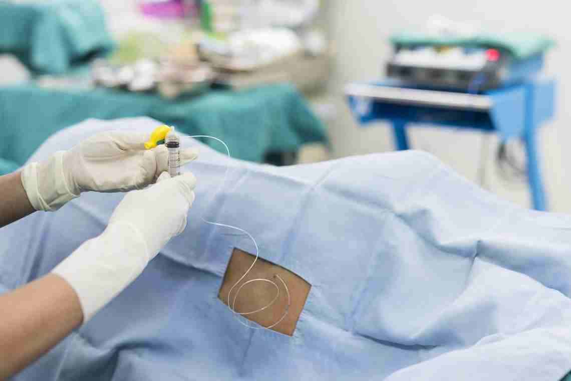 Чи можна робити епідуральну анестезію під час пологів?