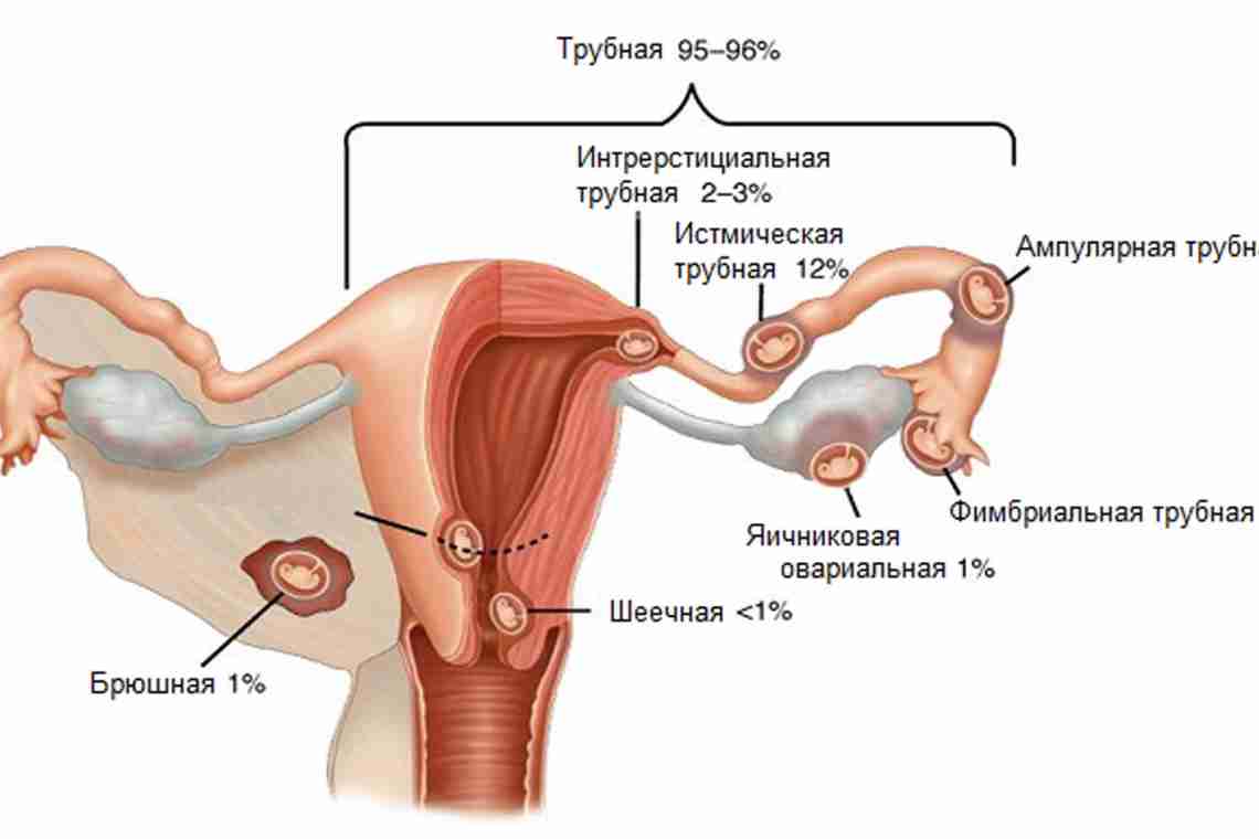 Як відрізнити трубну вагітність від маточної?
