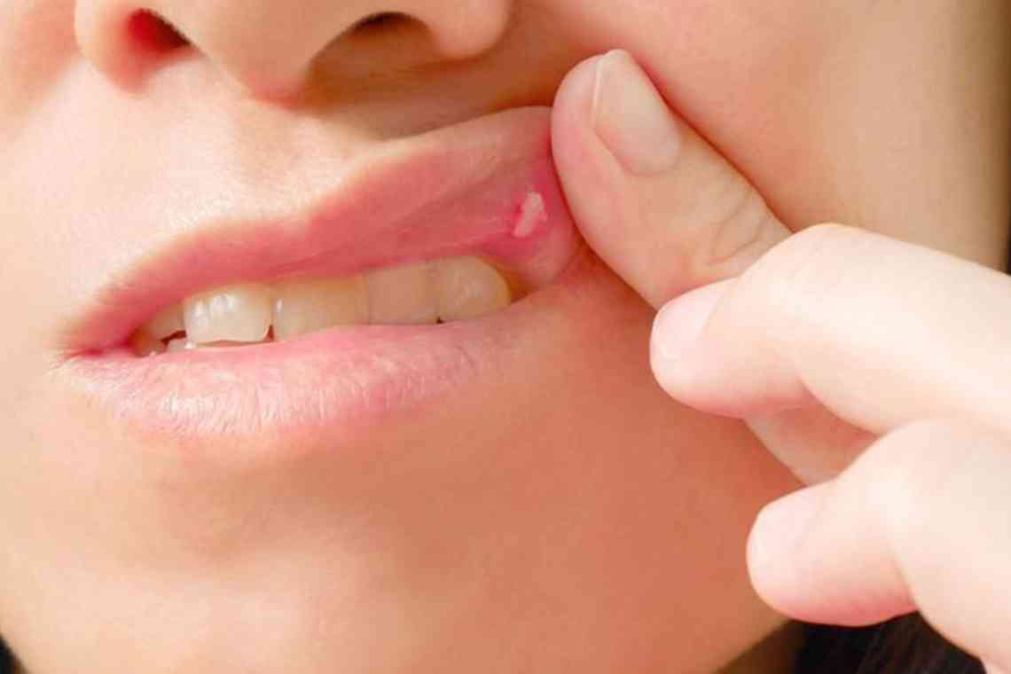 Як лікувати стоматит на статевих губах?