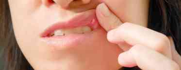 Як лікувати стоматит на статевих губах?