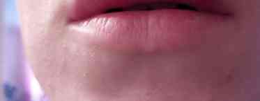 Прищі на статевих губах: чому вони виникають?