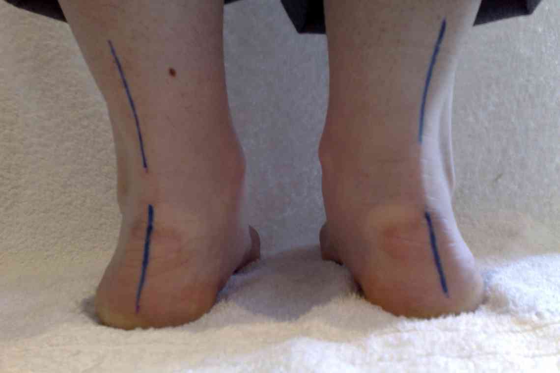 Вальгусна деформація ніг: причини патології та способи лікування