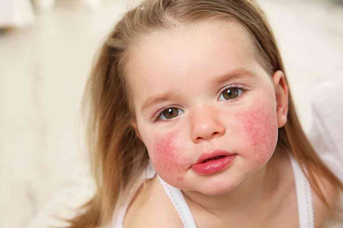 Чим і як лікується алергія?