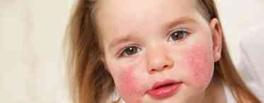 Алергія на глютен: причини, симптоми, лікування