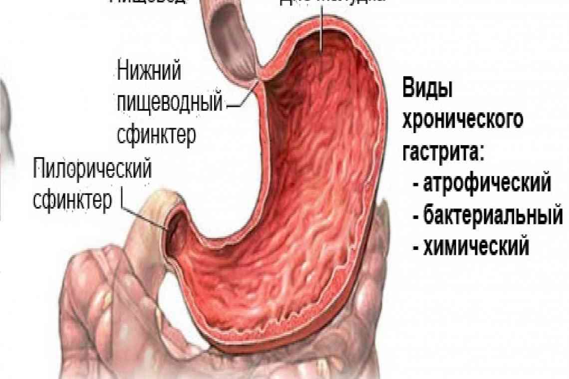 Антральний гастрит: причини, симптоми, лікування аптечними та народними засобами