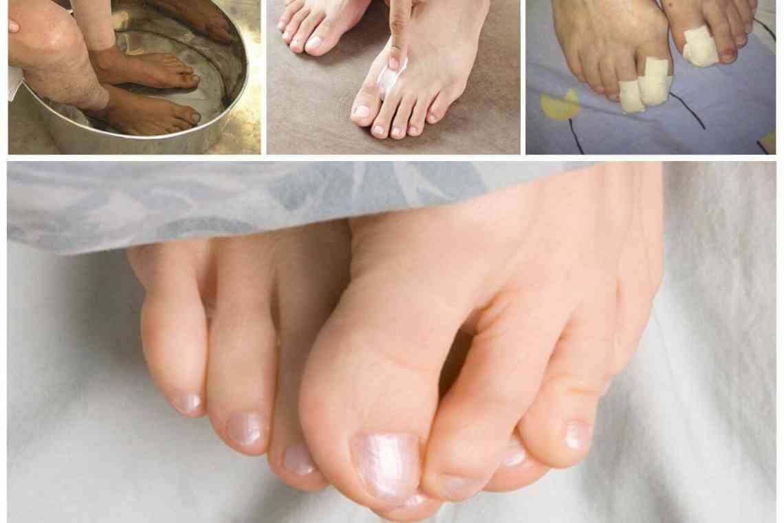 Видалення нігтя на нозі при грибку