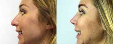  Види операцій на перегородці носа