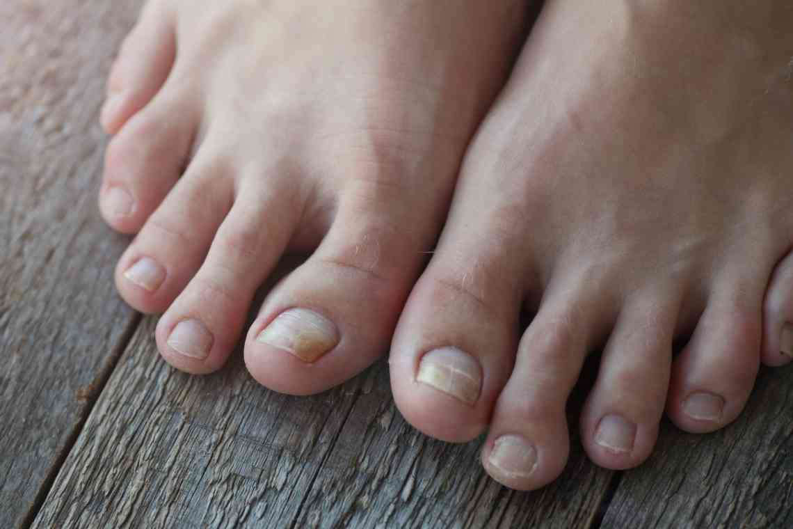 Олена Малишева про гриб нігтів на ногах