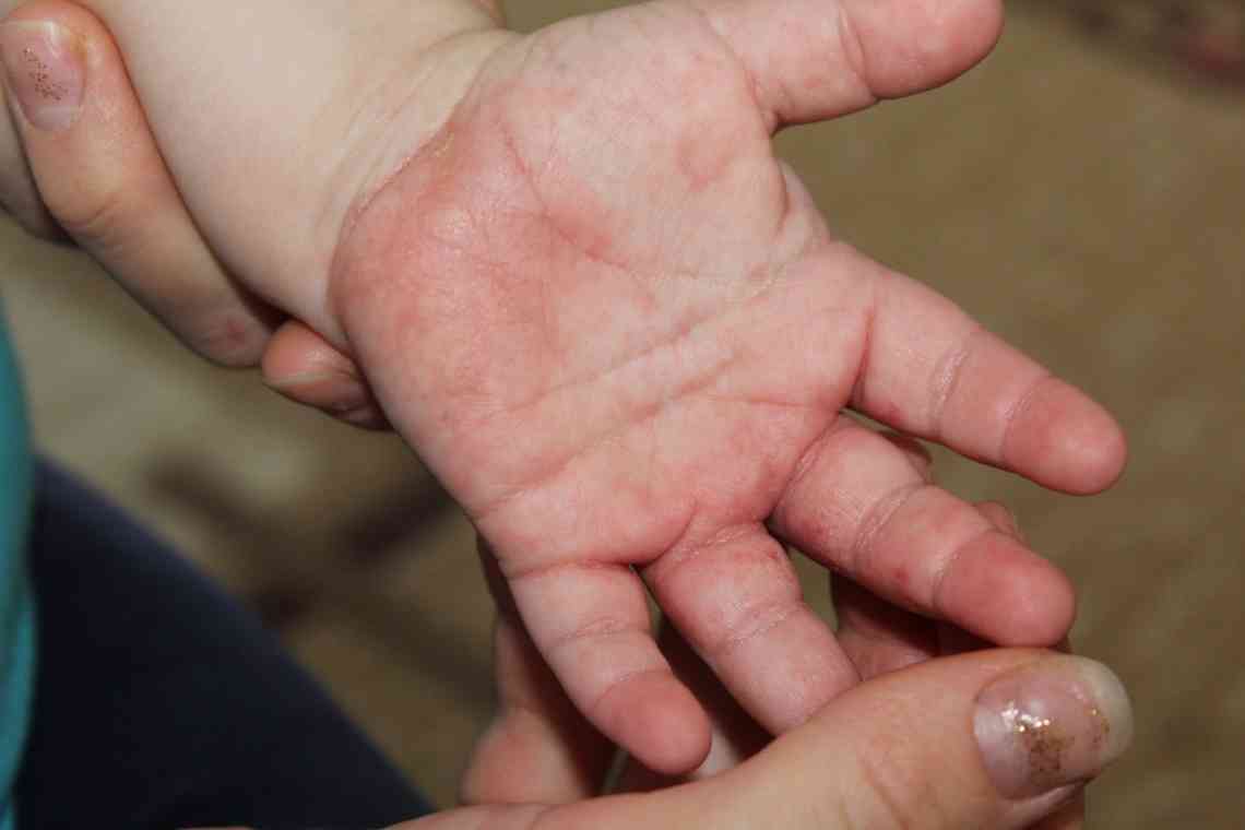 Холодні руки у дитини: в чому причина, і чи є привід для занепокоєння?
