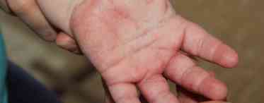 Холодні руки у дитини: в чому причина, і чи є привід для занепокоєння?