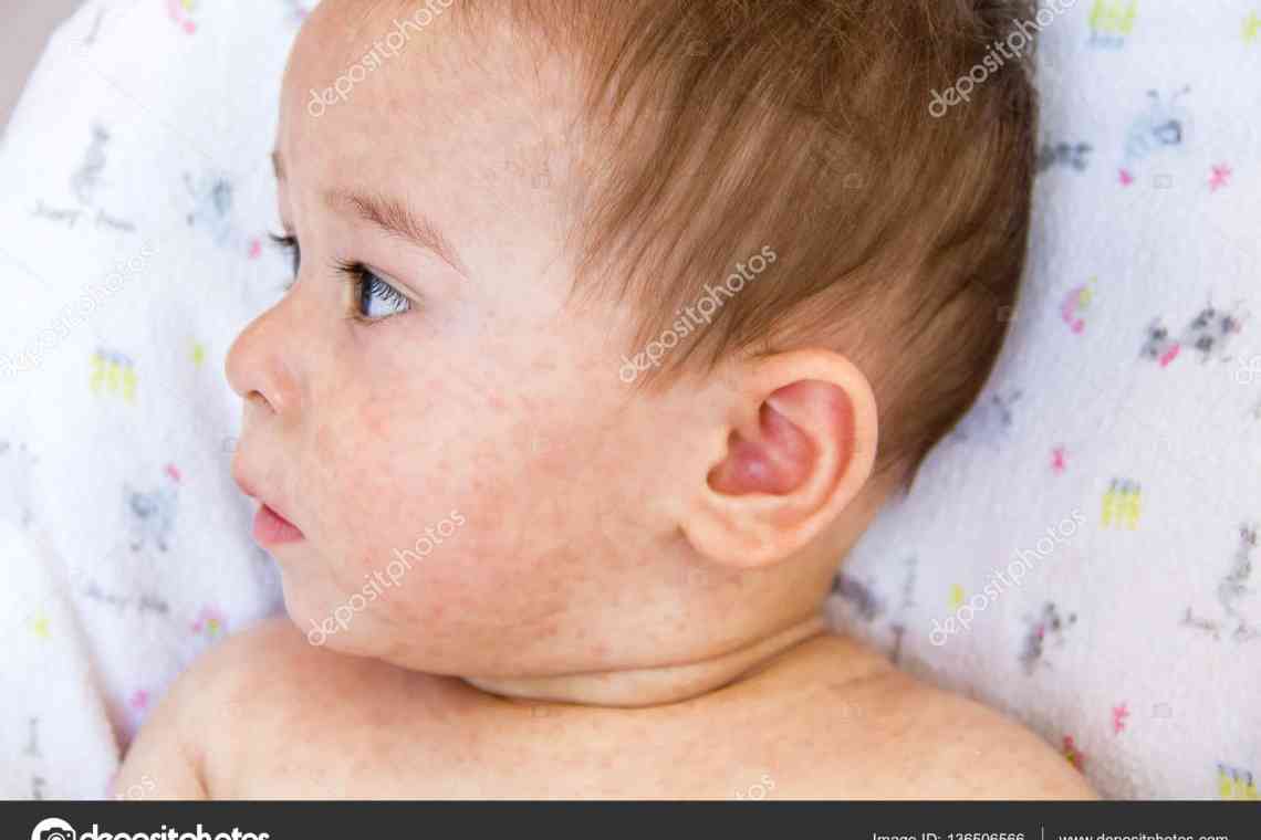 Алергічний дерматит у новонароджених - як позбавити кроху від страждань