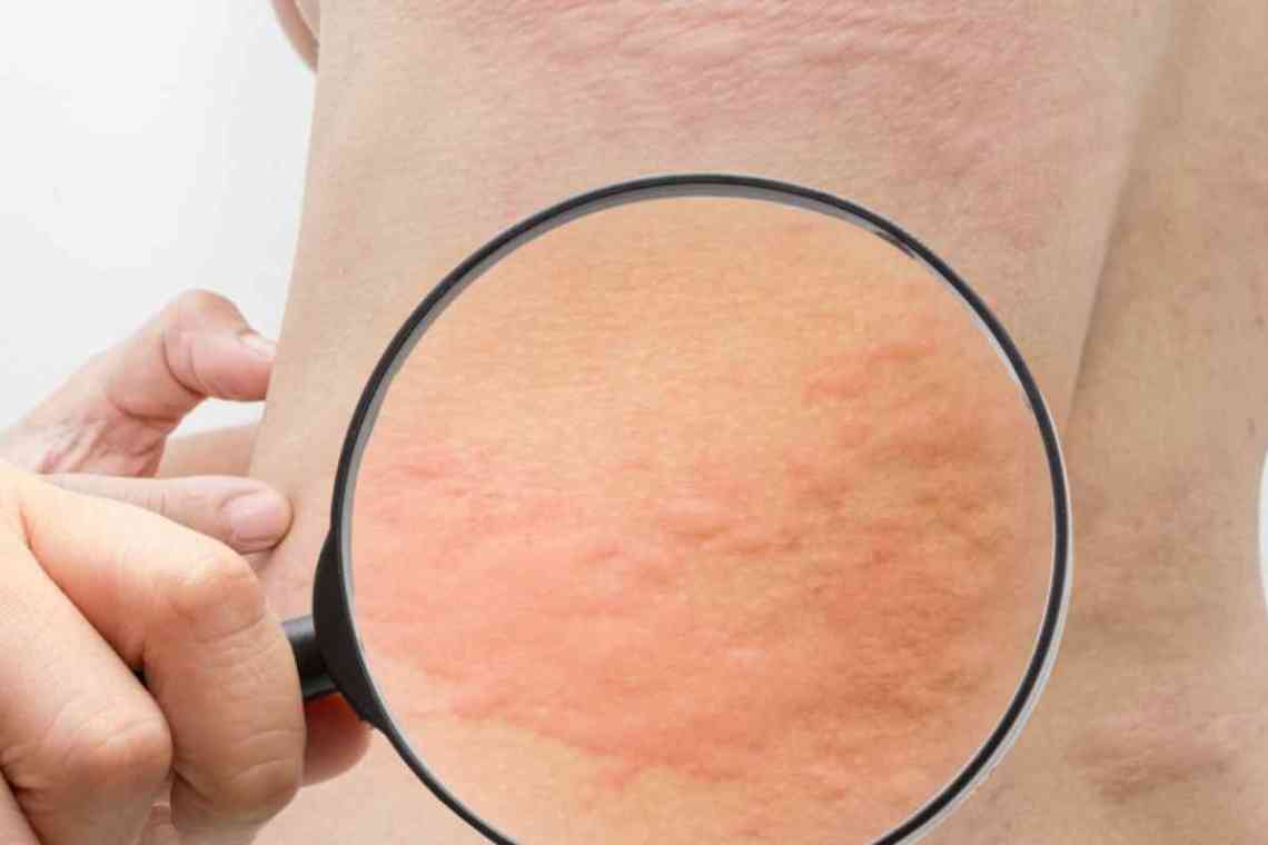 Причини мармурової шкіри у дорослих і методи боротьби з проблемою