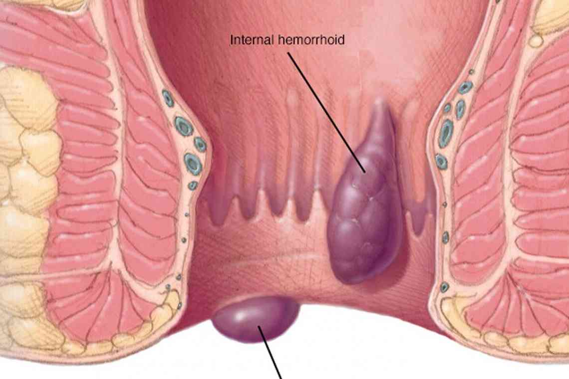 Як і чим лікуються гемороїдальні шишки?