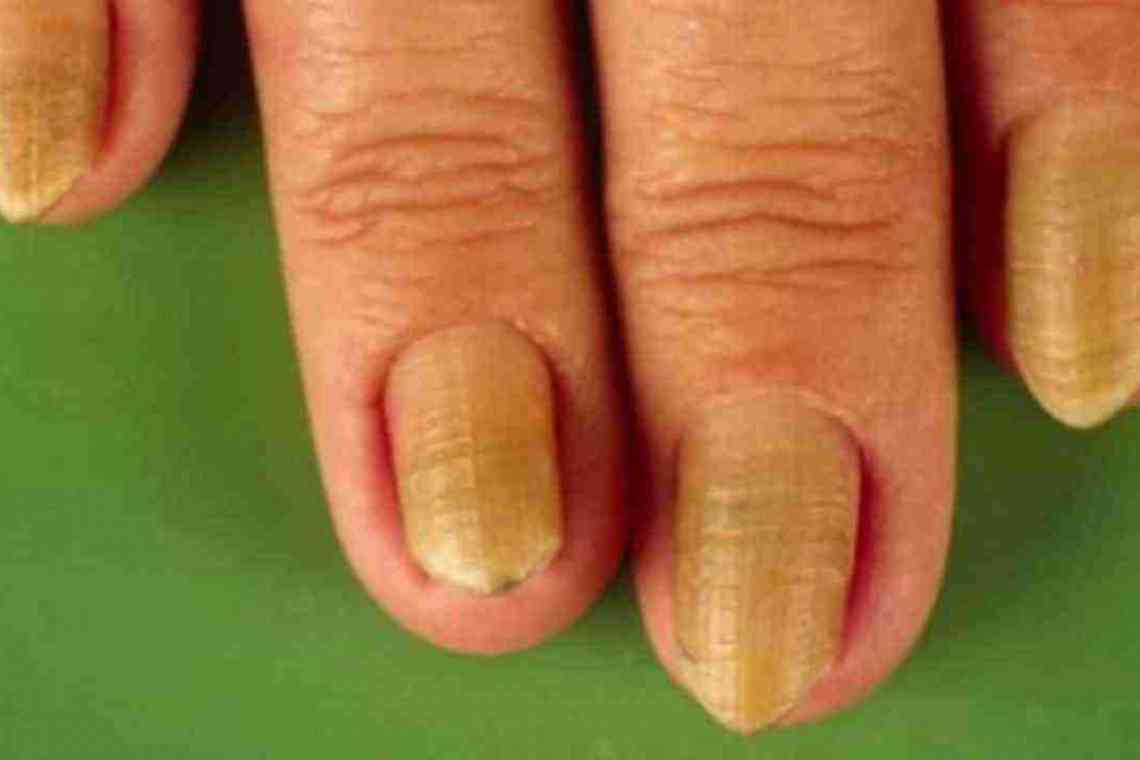 Як виявити і вилікувати дистрофію нігтя?