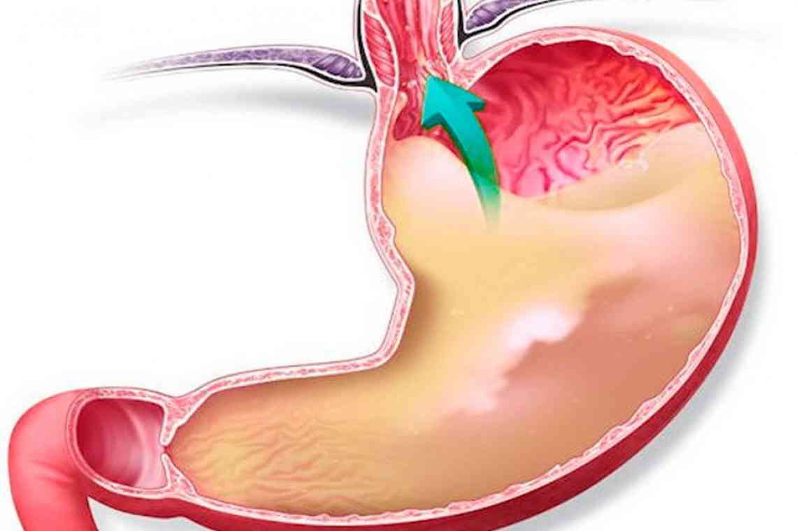 Підвищена кислотність шлунка: клінічна картина і лікування