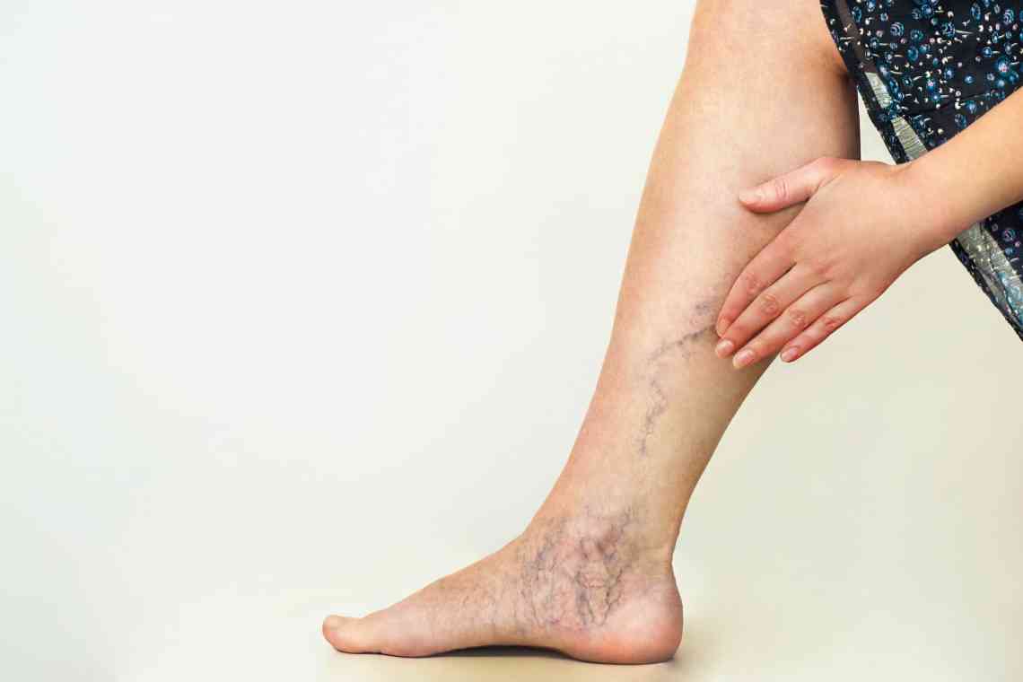 Болять вени на ногах: як впоратися з проблемою?