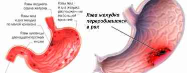 Про що свідчить кровотеча шлункова?