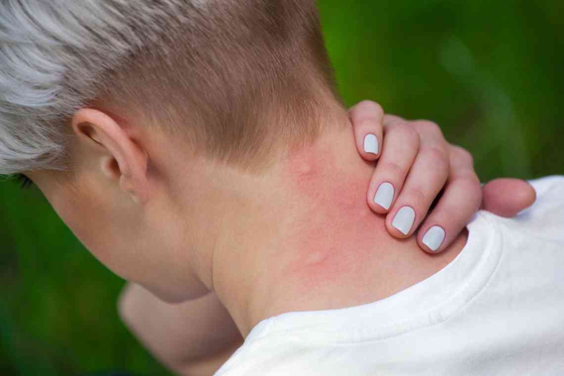Симптоми алергії на укус комахи