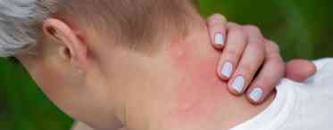 Симптоми алергії на укус комахи