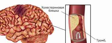 Симптоми слабких судин тіла і головного мозку