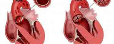Аортальна вада серця: причини, симптоми, лікування