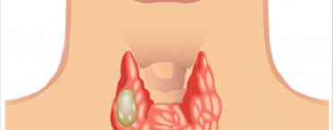 Наскільки небезпечна кіста щитовидної залози?