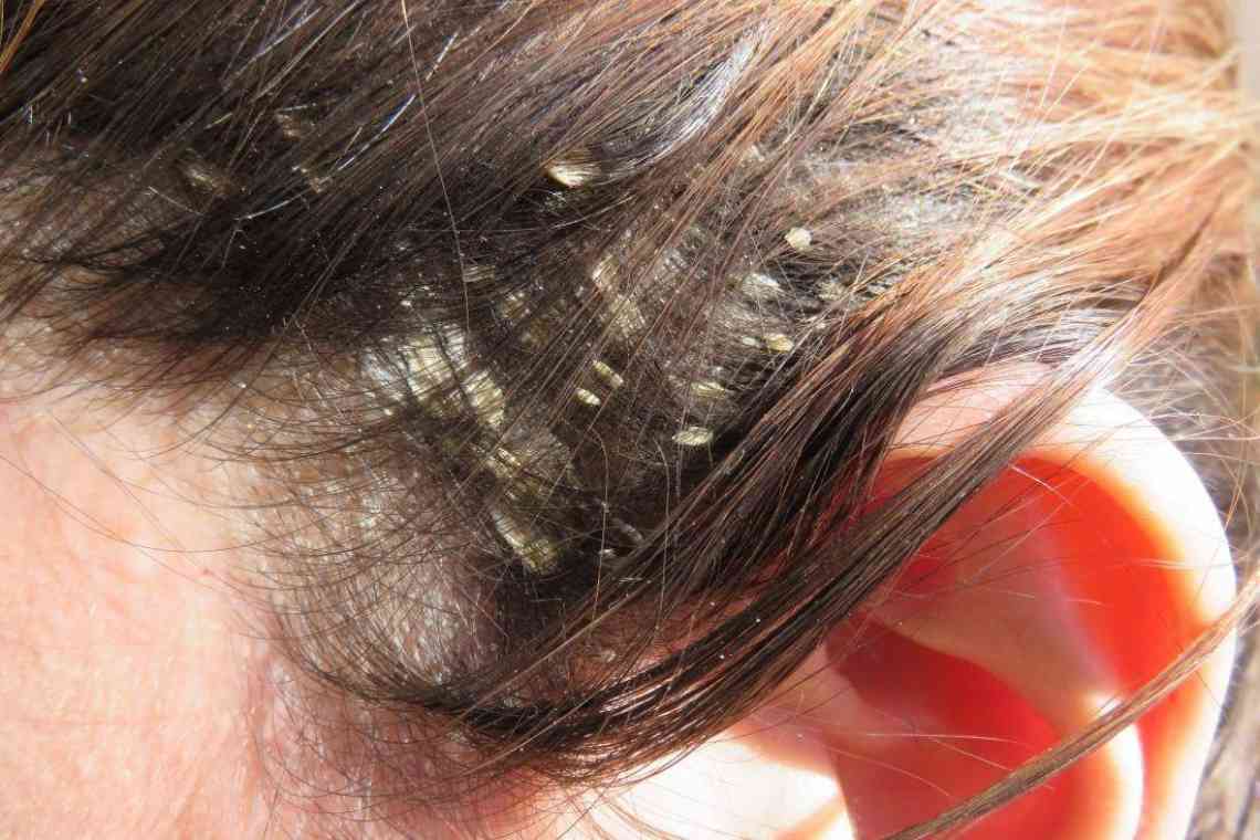 Хвороби шкіри голови: як розпізнати