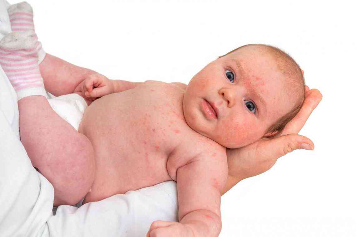 Як виявити і вилікувати алергічний дерматит у дітей?