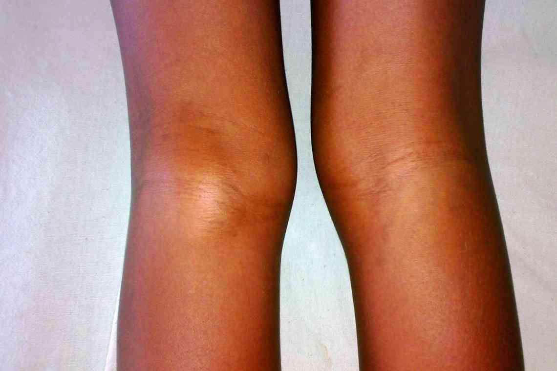 Як правильно лікувати забій коліна