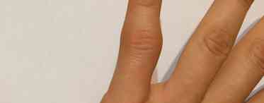 Побутові травми у дітей: що зробити, якщо малюк прищемив палець?
