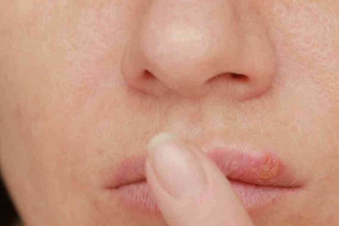 Постійний герпес на губах: ефективно боремося з недугою